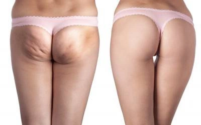 Bańki Chińskie Silikonowe do Masażu Ciała i Twarzy SOULIMA